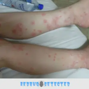 bed bugs on legs