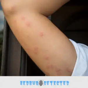 bed bugs bite on arm
