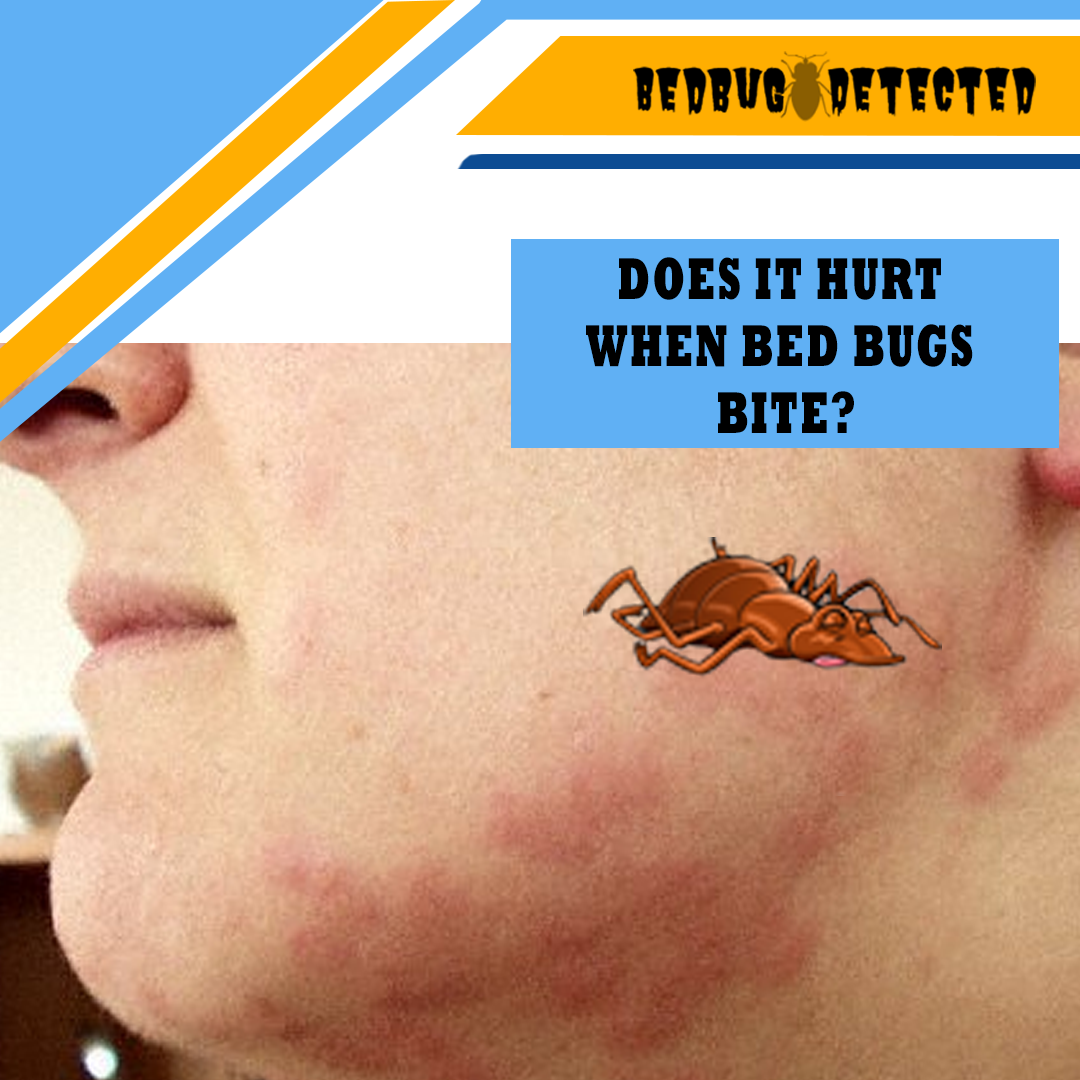DOES IT HURT WHEN BED BUGS BITE?