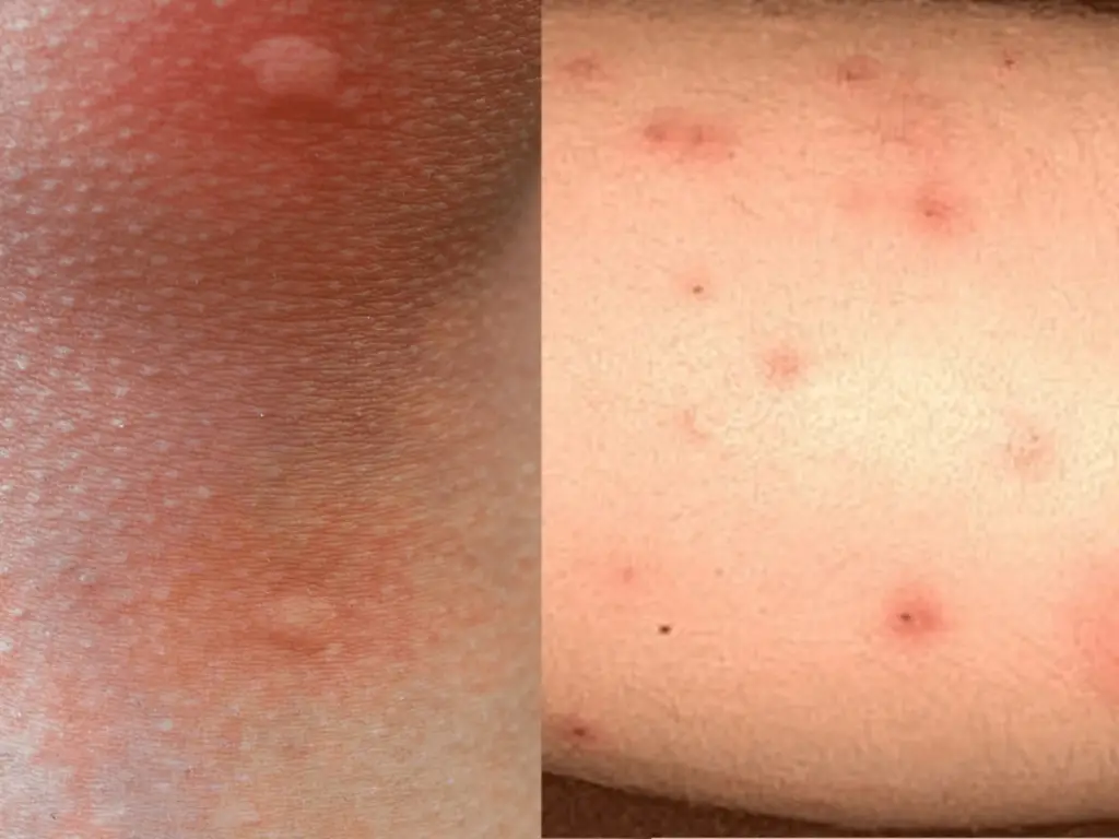 bed-bug-bites-vs-mosquito-bites-similarities-and-differences-photos