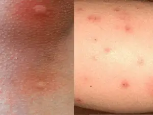 What’s the difference between bed bug bites vs mosquito bites